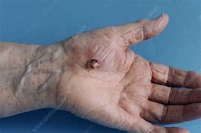 Image result for Pyogenic Granuloma Hand