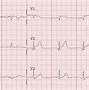 Image result for Ongoing ECG