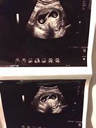 Image result for 5 Weeks Pregnant Ultrasound Twins