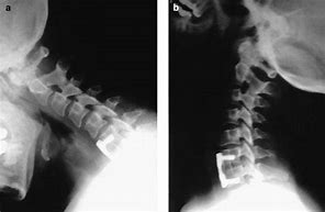 Image result for Hyperflexion of Spine in Intrauterine Death