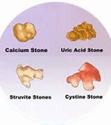 Image result for 4 Cm Kidney Stone