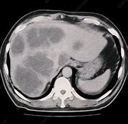 Image result for Liver Cancer MRI
