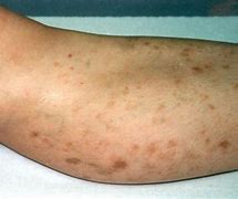 Image result for Purpuric Dermatosis