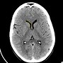 Image result for Normal Brain CT Scan Head