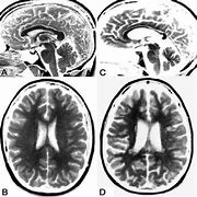 Image result for Rapidly Shrinking Brain