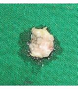 Image result for Papilloma On Uvula