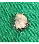 Image result for Pedunculated Papilloma