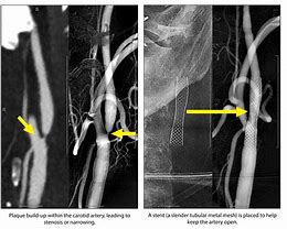 Image result for Carotid Artery In-Stent Stenosis