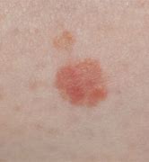 Image result for What Do Different Types of Skin Cancer Look Like
