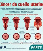 Image result for Cancer De Cervix