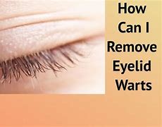 Image result for Treatment for Warts On Eyelids