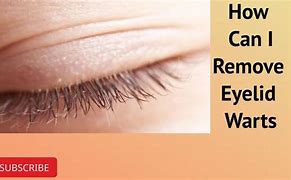 Image result for Eyelid Wart Removal Surgery
