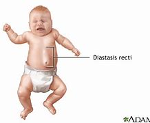 Image result for Diastasis Recti Newborn