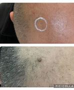 Image result for Scalp Wart Removal