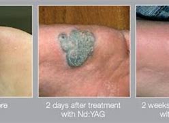 Image result for Wart Removal On Leg