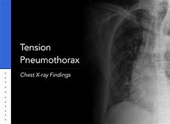 Image result for Tension Pneumothorax Chest X-ray