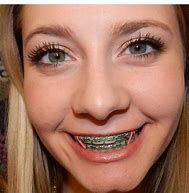 Image result for Beautiful Braces Colors