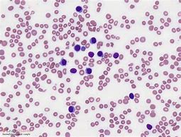 Image result for Hairy Cell Leukemia Splenomegaly