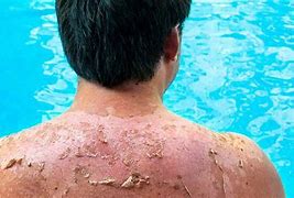 Image result for Skin Cancer From SunBurn