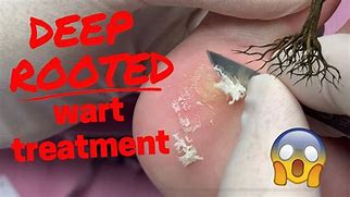 Image result for Wart Root Sticking Out