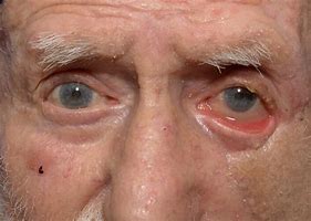 Image result for Ectropion of the Eye
