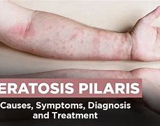 Image result for Eczema vs Keratosis Pilaris