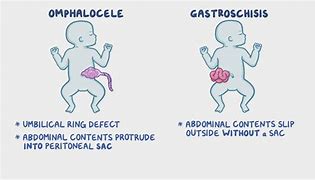 Image result for Gastroschisis