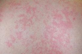 Image result for Rash with Strep Throat