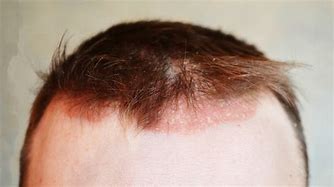 Image result for Eczema On the Scalp