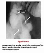 Image result for Apple Core Sign Esophagus