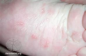 Image result for Scabies Eczema