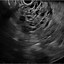 Image result for Anechoic Fluid On Ultrasound