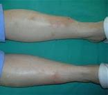 Image result for mixedema