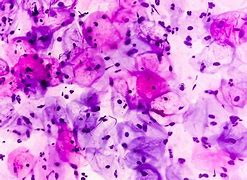 Image result for HPV Cells
