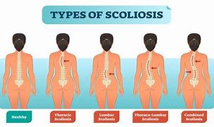 Image result for Bottom of Back Scoliosis