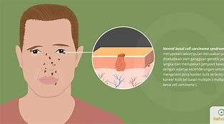 Image result for Cayenne Pepper Basal Cell Carcinoma