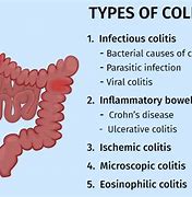 Image result for colitis