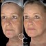 Image result for Juvederm Cheek Filler