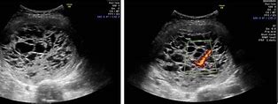 Image result for Large Fibroid Uterus