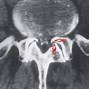 Image result for Normal MRI Lower Lumbar Spine