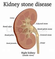 Image result for Kidney Stones Drawing