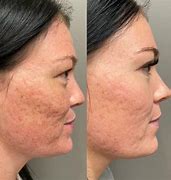 Image result for RadioFrequency MicroNeedling
