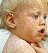 Image result for Measles in Babies