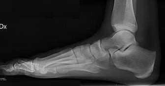 Image result for Right Foot X-ray