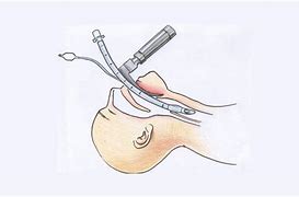 Image result for intubar