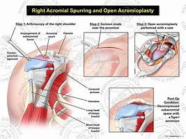 Image result for acromial