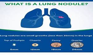 Image result for Lung Nodule Size Chart