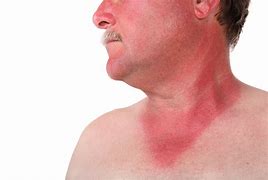 Image result for Stages of SunBurn