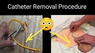 Image result for Femoral Catheter Removal