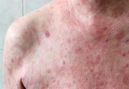 Image result for Melanoma Skin Cancer Rash